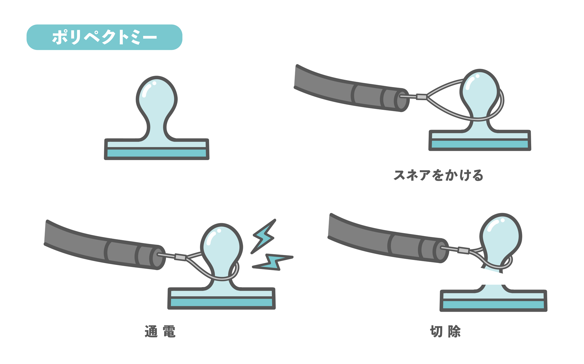 ポリペクトミー（HSP）の手順を示すイラスト。隆起したポリープにスネアをかけ、高周波電流で通電し、切除する流れを4段階で示している。