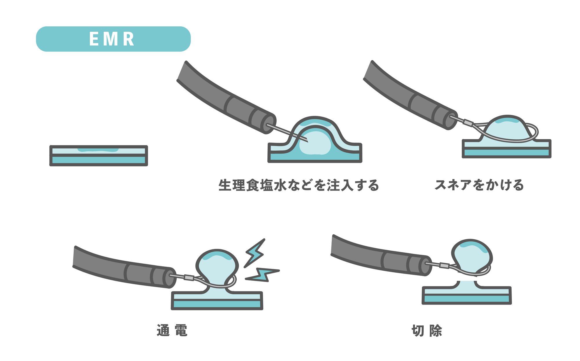 内視鏡的粘膜切除術（EMR）の手順を示すイラスト。平坦な病変に生理食塩水を注入して隆起させ、スネアをかけて通電し、切除する流れを5段階で示している。